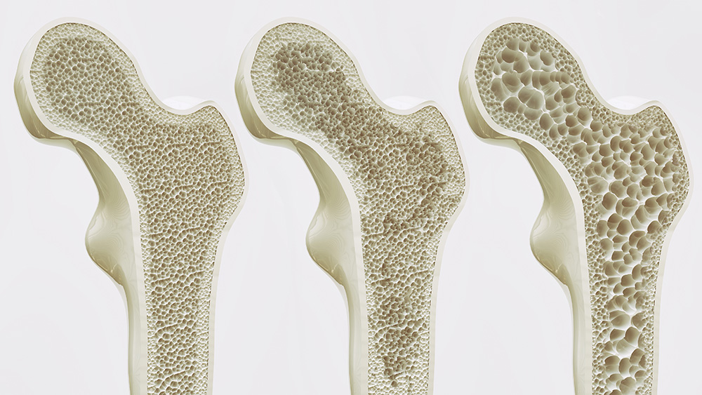 Phases of Osteoporosis and bone density